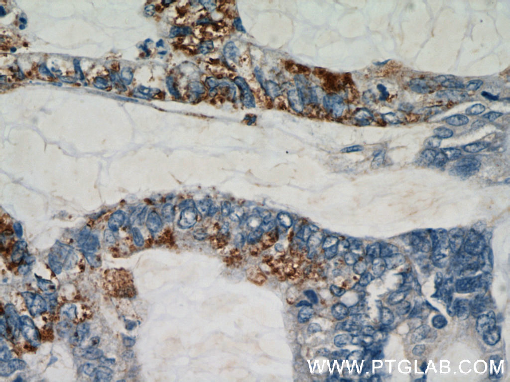 IHC staining of human colon cancer using 12290-1-AP