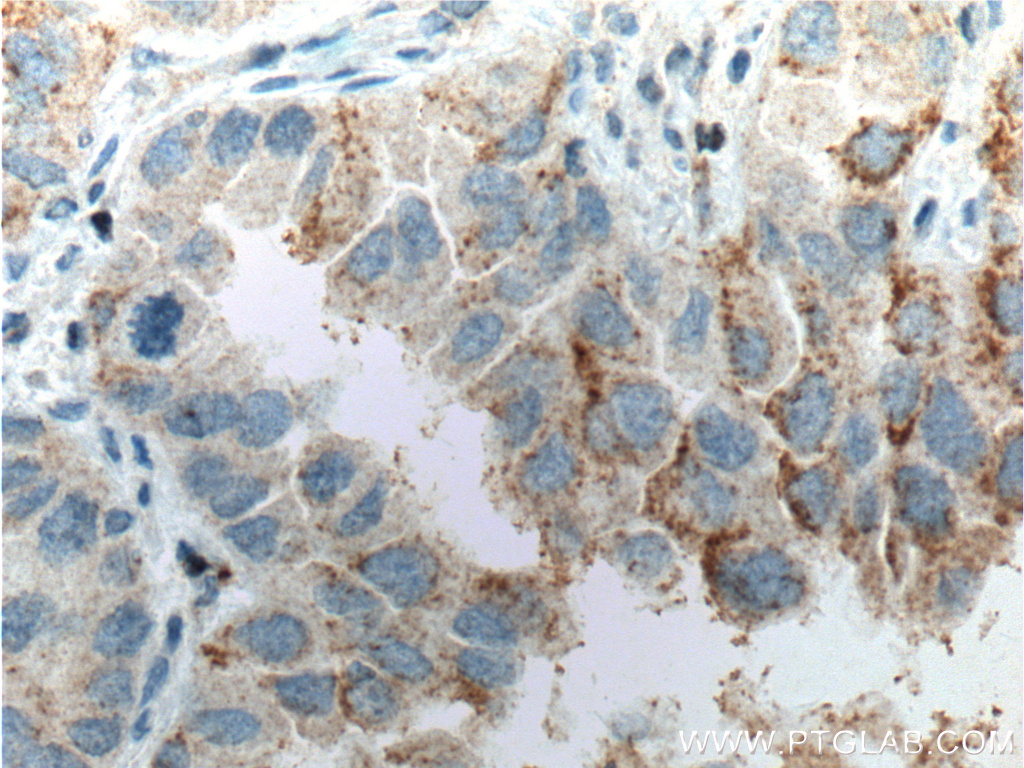 IHC staining of human lung cancer using 26620-1-AP