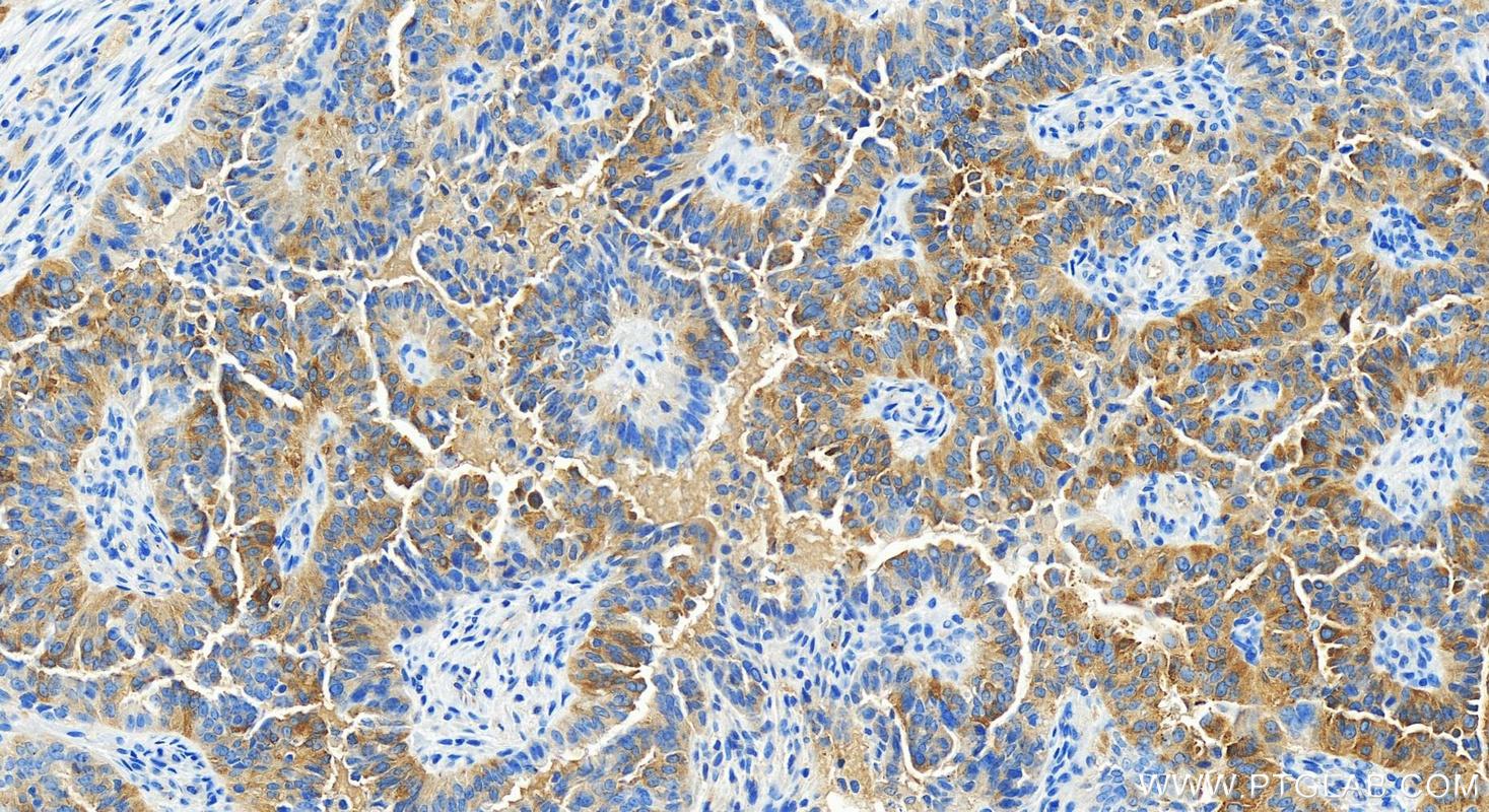 IHC staining of human ovarian  cancer using 82996-4-RR (same clone as 82996-4-PBS)