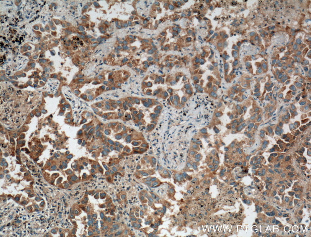 IHC staining of human lung cancer using 26458-1-AP