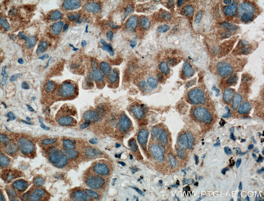 IHC staining of human lung cancer using 26458-1-AP