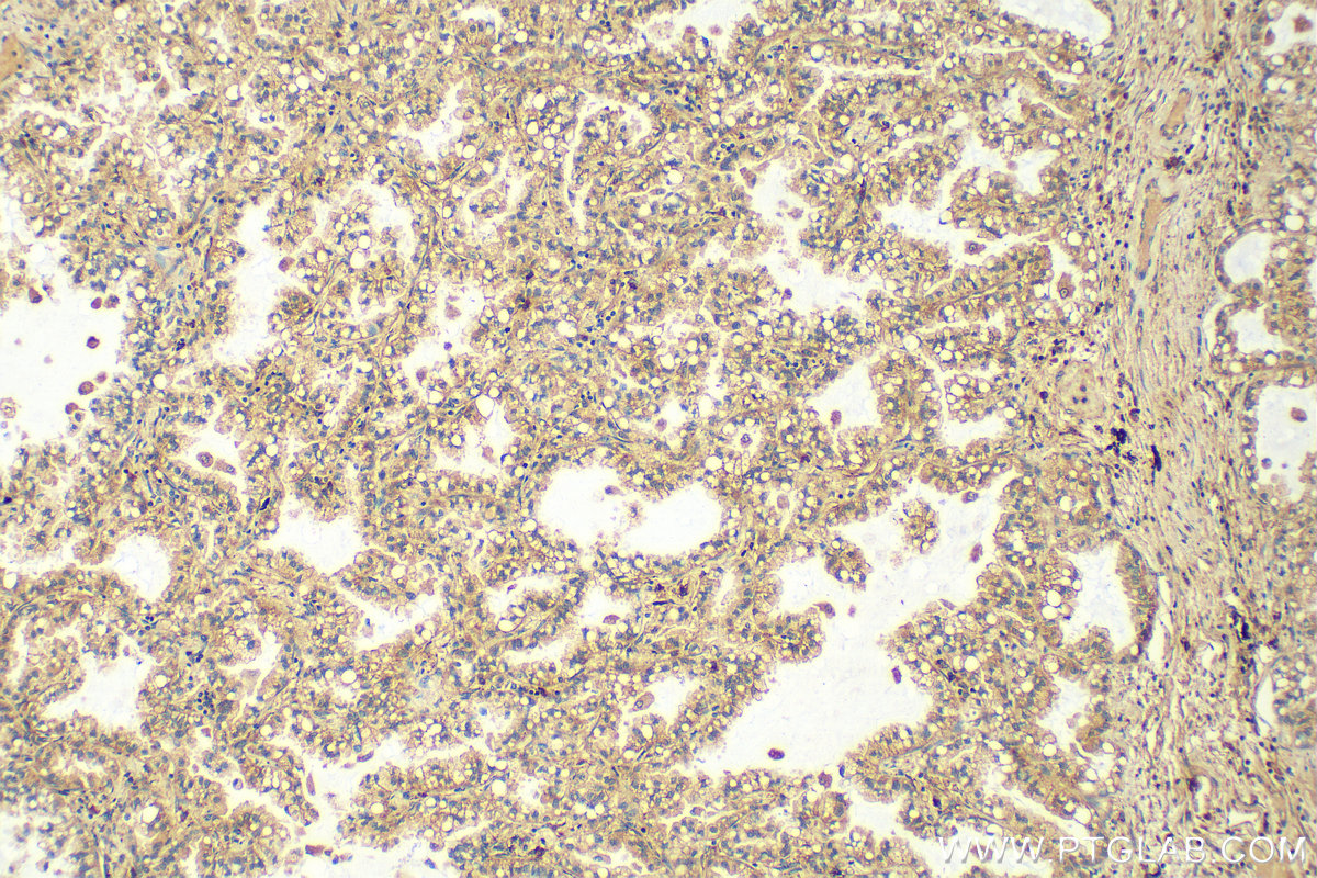 IHC staining of human lung cancer using 14630-1-AP