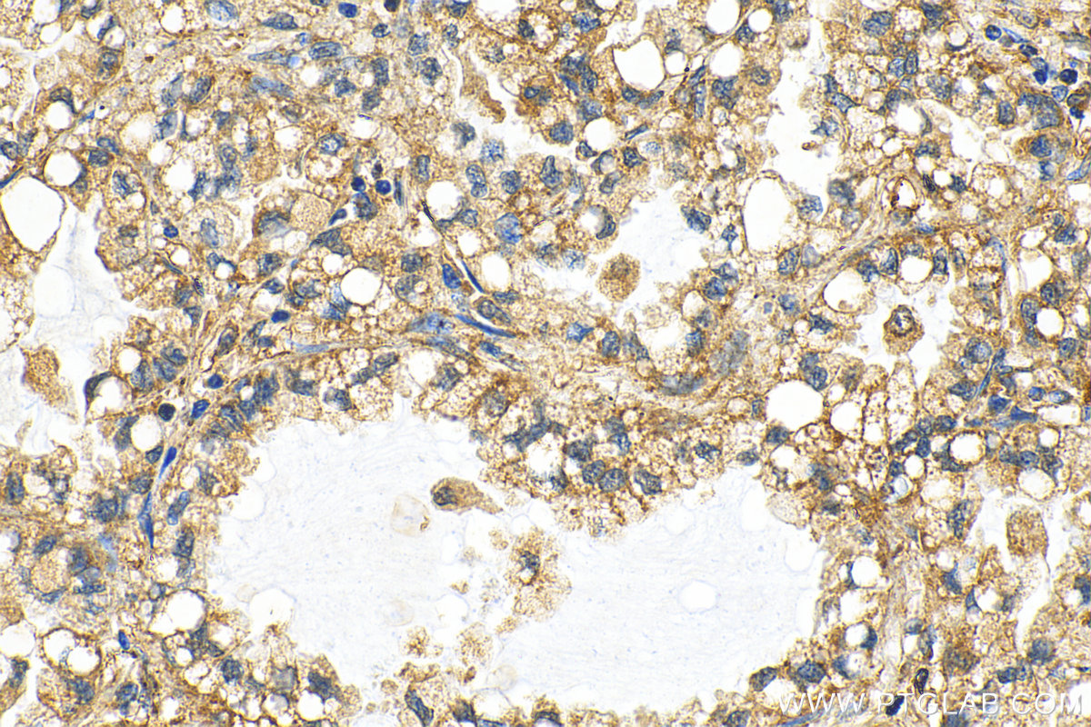 IHC staining of human lung cancer using 14630-1-AP