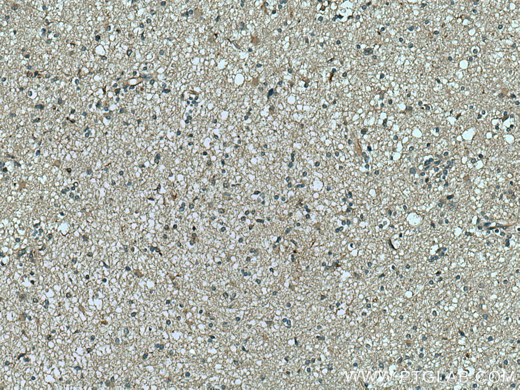 IHC staining of human gliomas using 17203-1-AP