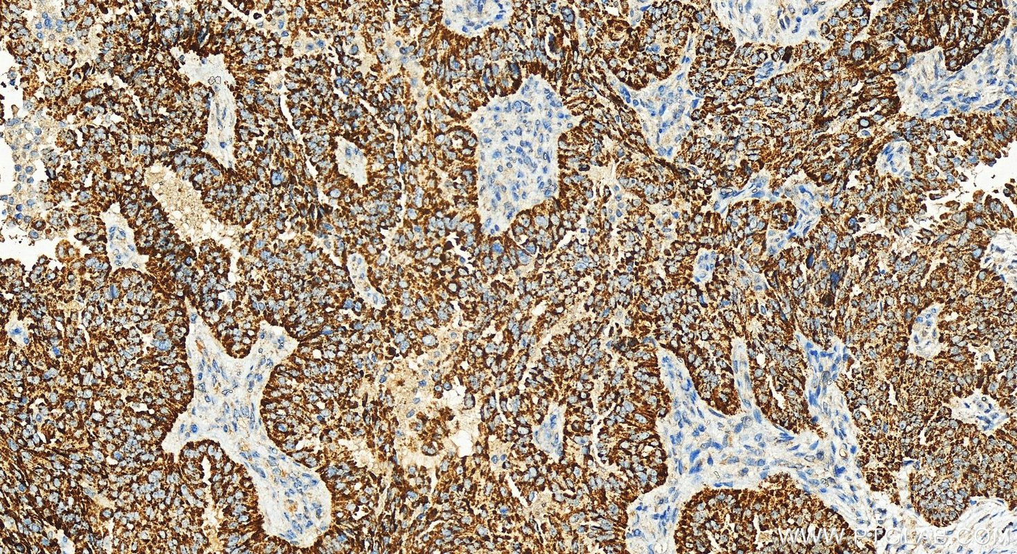 IHC staining of human ovarian  cancer using 82771-1-RR (same clone as 82771-1-PBS)