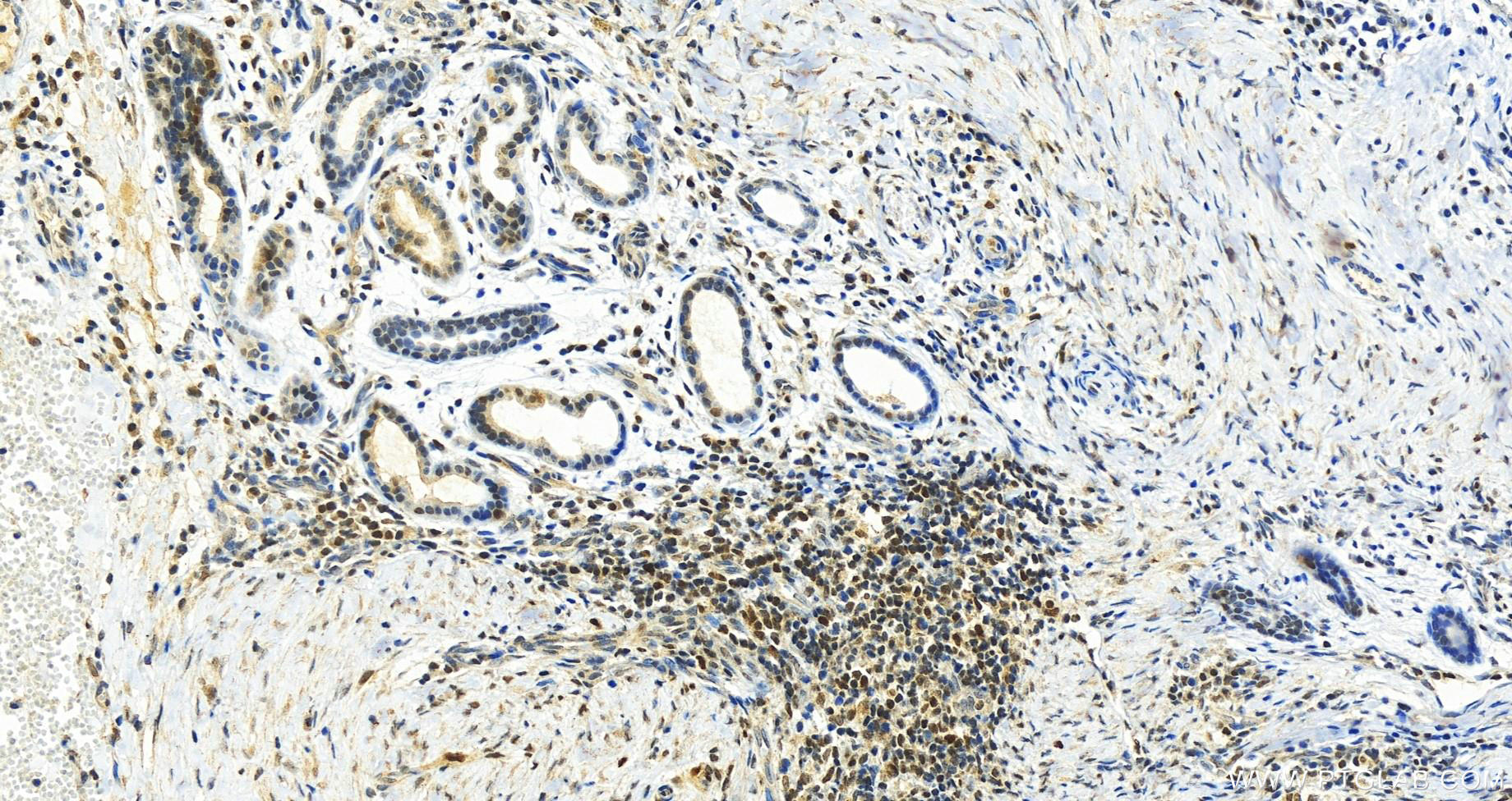 IHC staining of human skin cancer using 67976-1-Ig (same clone as 67976-1-PBS)