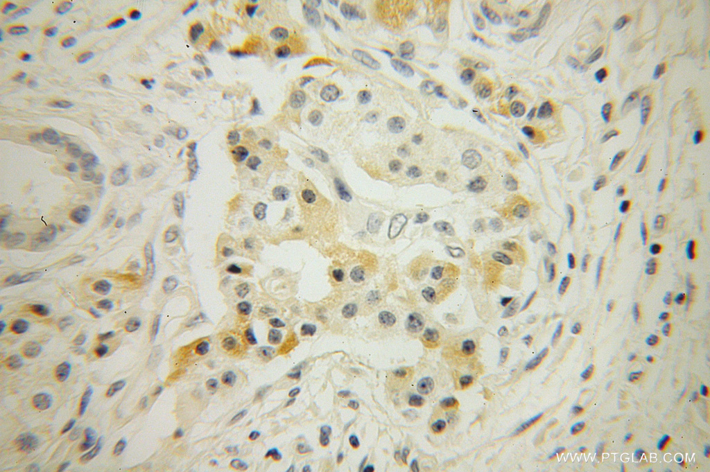 IHC staining of human pancreas cancer using 13753-1-AP