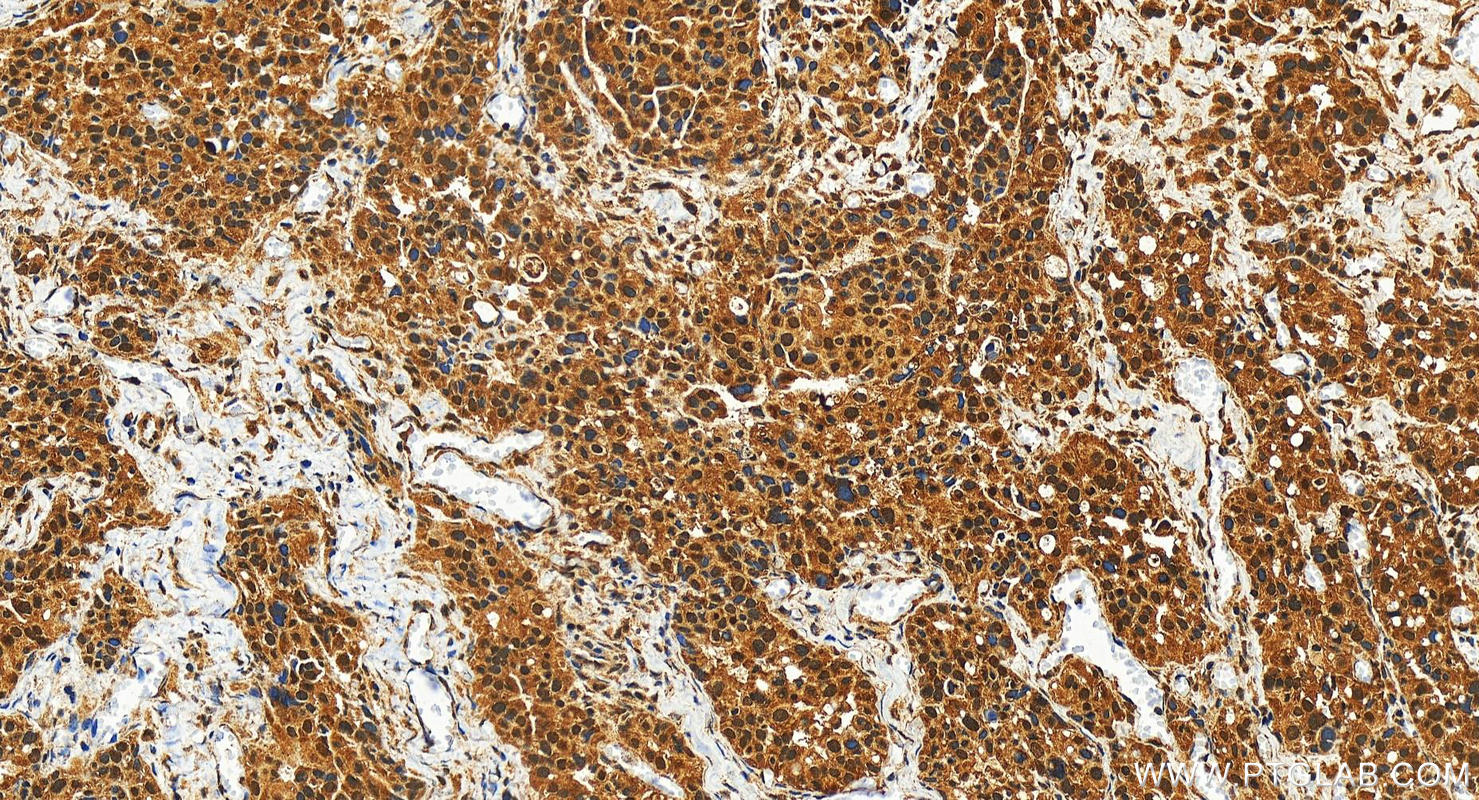 IHC staining of human ovary cancer using 27018-1-AP