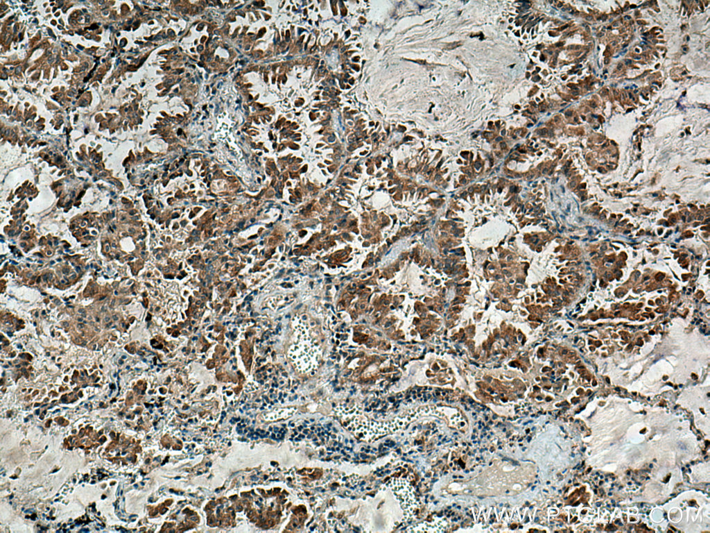 IHC staining of human lung cancer using 24524-1-AP