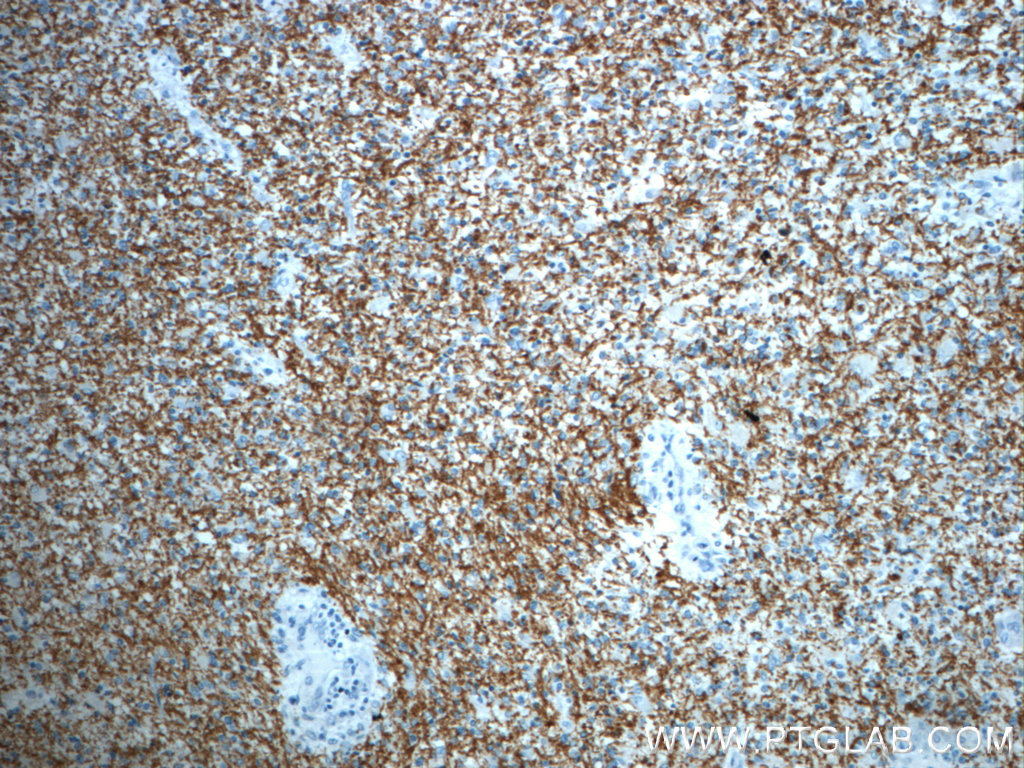 IHC staining of human gliomas using 20220-1-AP