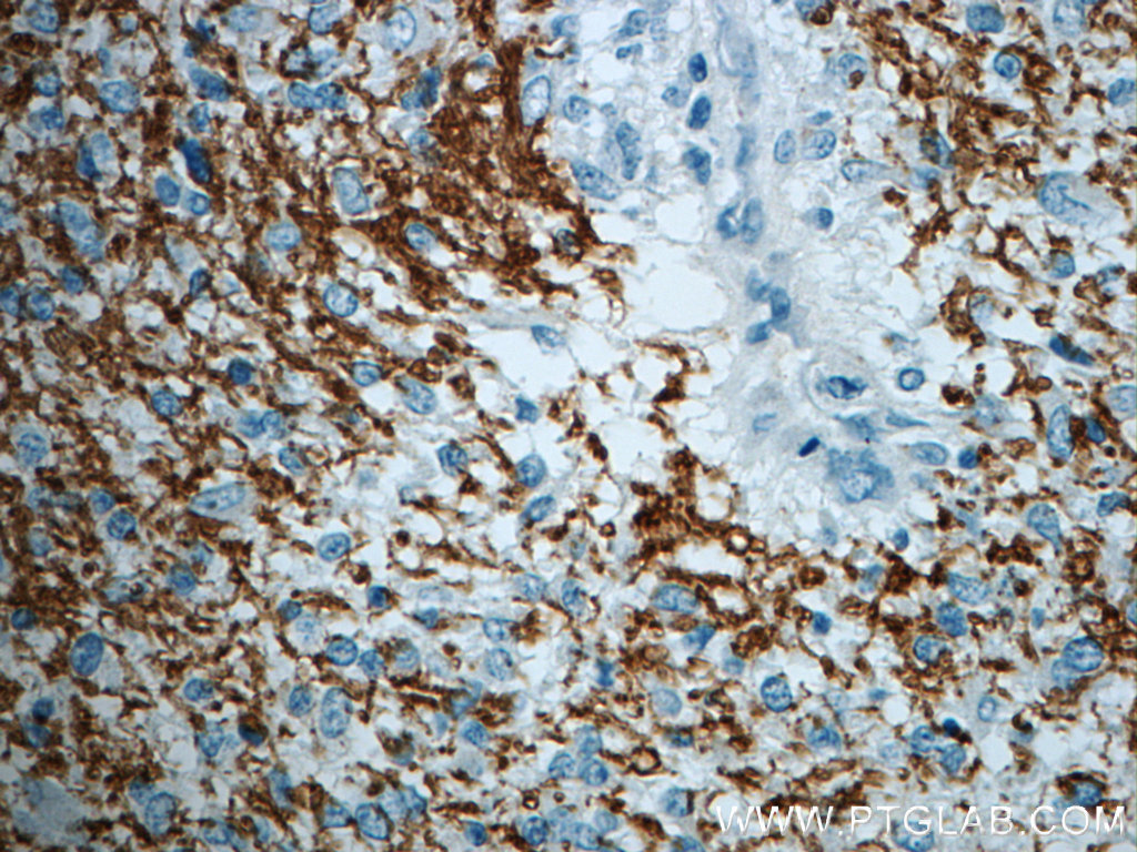 IHC staining of human gliomas using 20220-1-AP