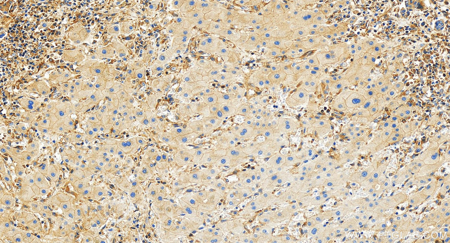 IHC staining of human intrahepatic cholangiocarcinoma using 83166-5-RR