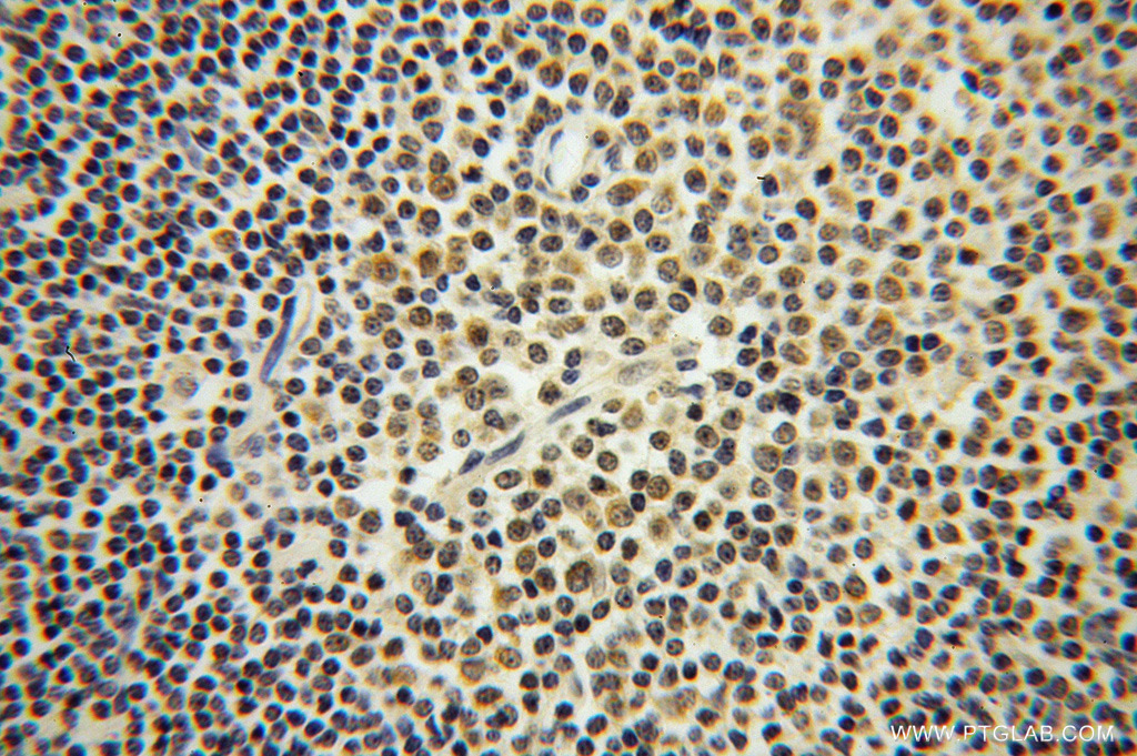 IHC staining of human lymphoma using 14027-1-AP