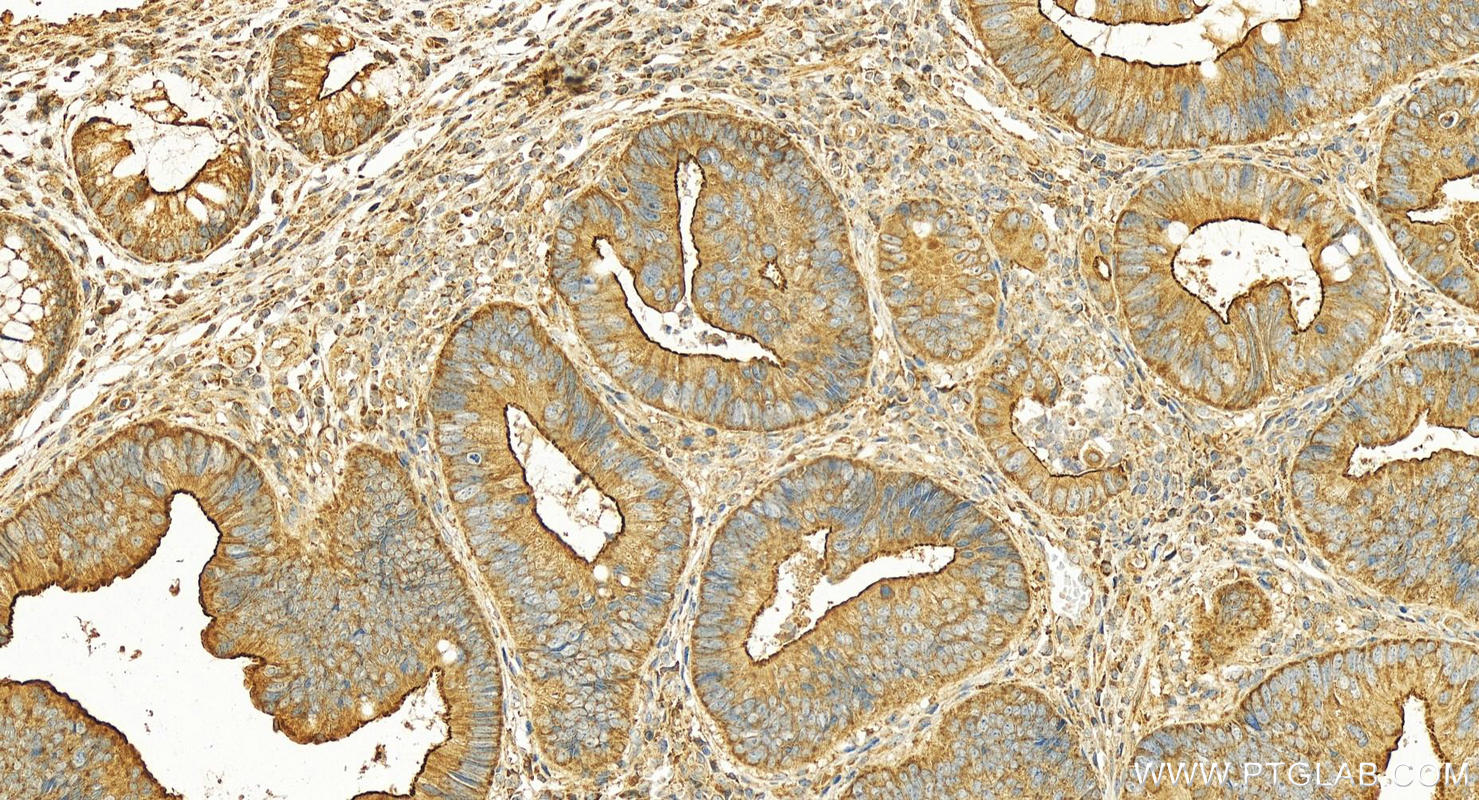 IHC staining of human colon cancer using 12565-1-AP