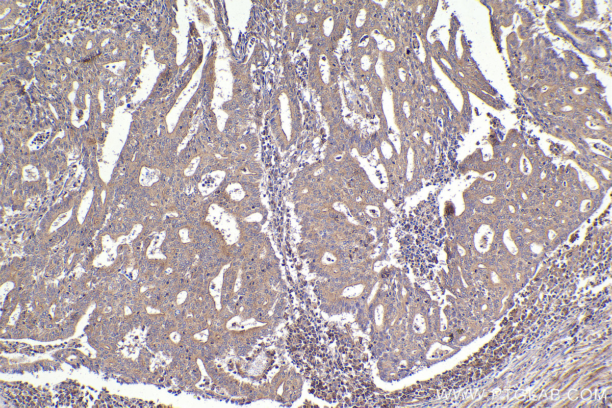 IHC staining of human endometrial cancer using 14536-1-AP