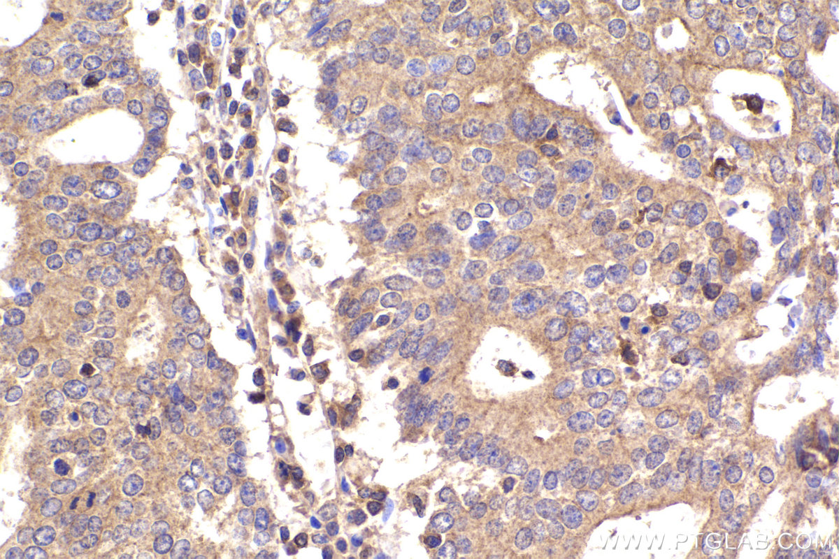 IHC staining of human endometrial cancer using 14536-1-AP