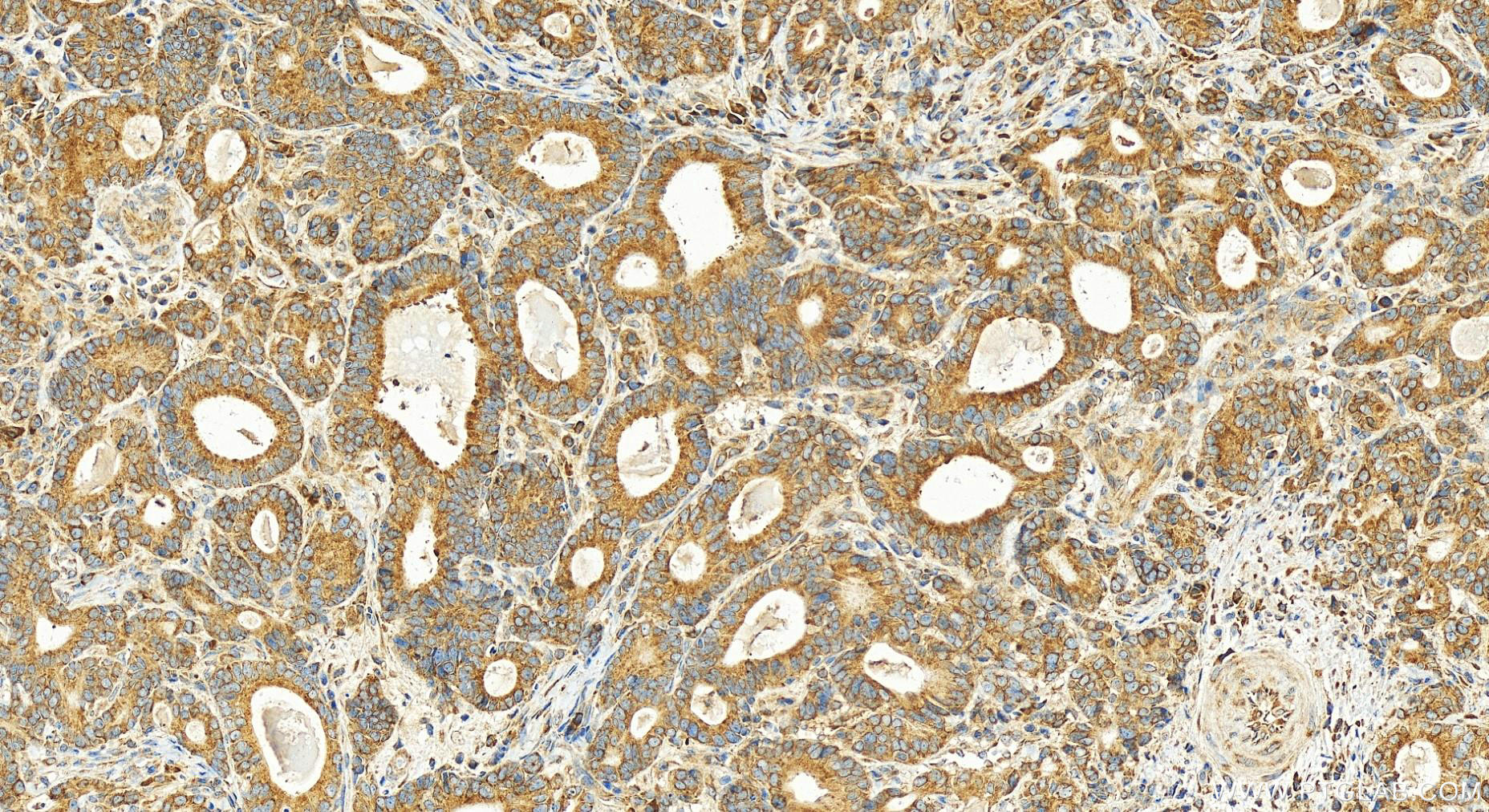 IHC staining of human stomach cancer using 14633-1-AP