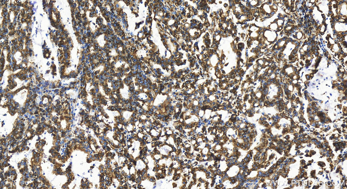 IHC staining of human stomach cancer using 83928-1-RR (same clone as 83928-1-PBS)