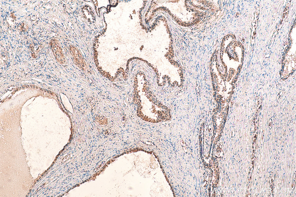 IHC staining of human prostate cancer using 11005-1-AP (same clone as 11005-1-PBS)