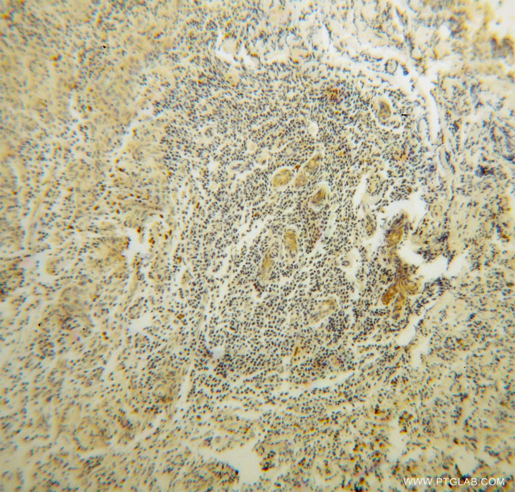 IHC staining of human breast cancer using 14660-1-AP