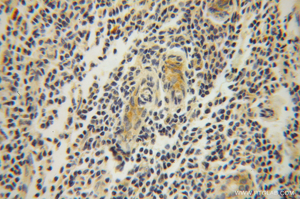 IHC staining of human breast cancer using 14660-1-AP