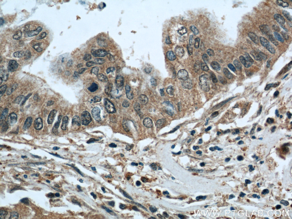 IHC staining of human pancreas cancer using 15055-1-AP