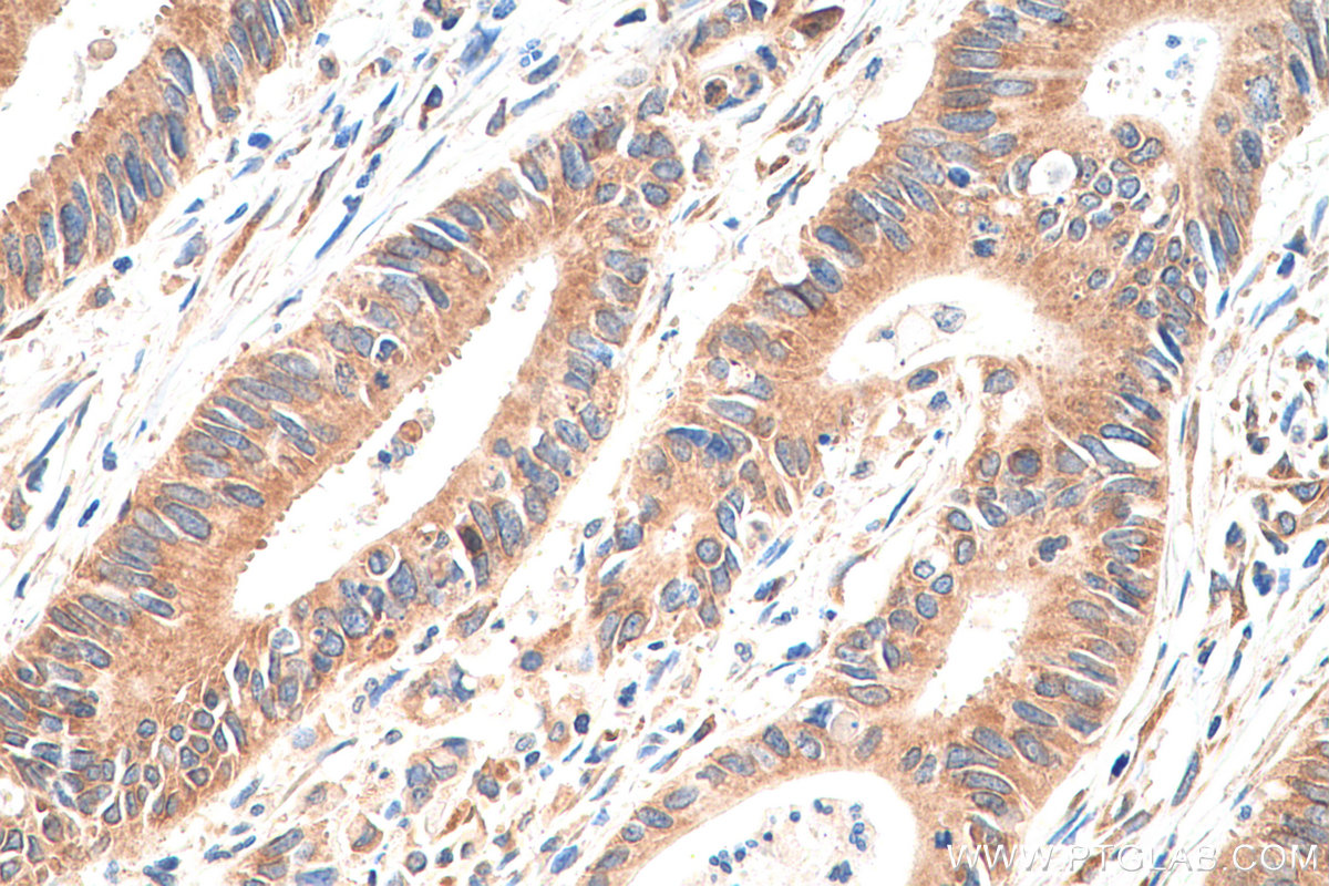IHC staining of human colon cancer using 68056-1-Ig (same clone as 68056-1-PBS)