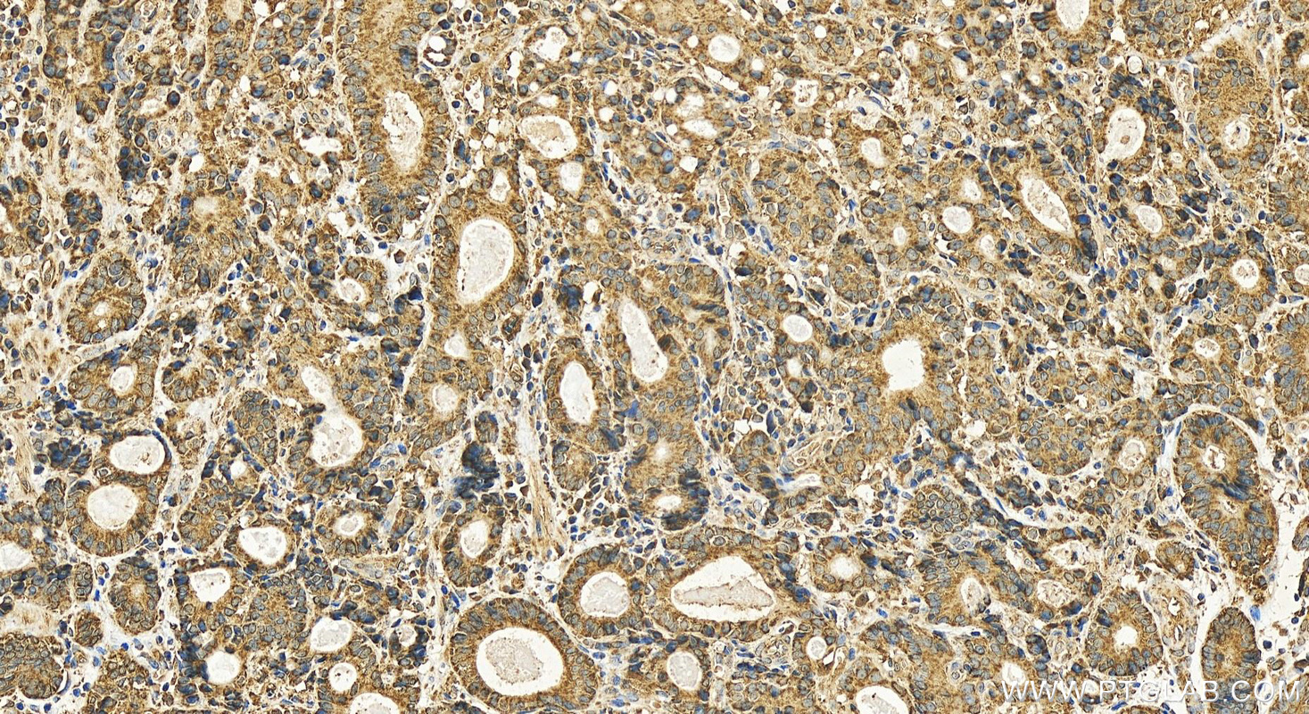 IHC staining of human stomach cancer using 83250-2-RR