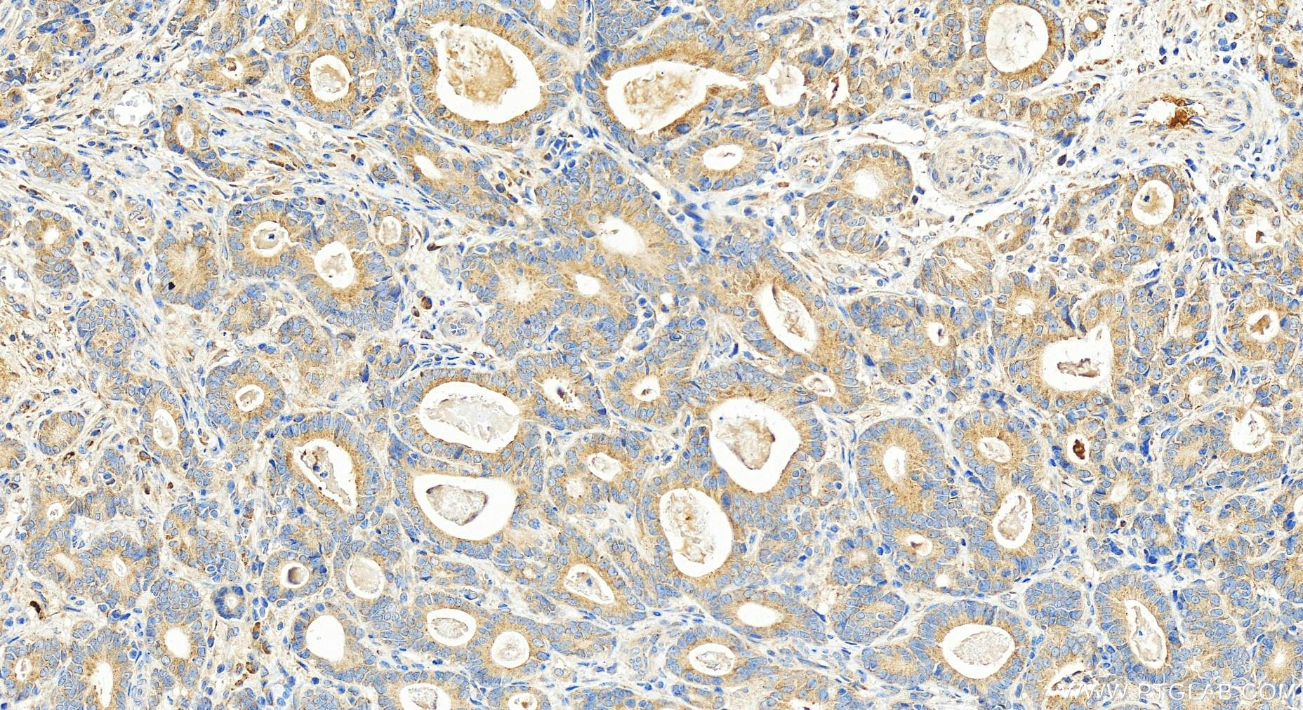 IHC staining of human stomach cancer using 15942-1-AP