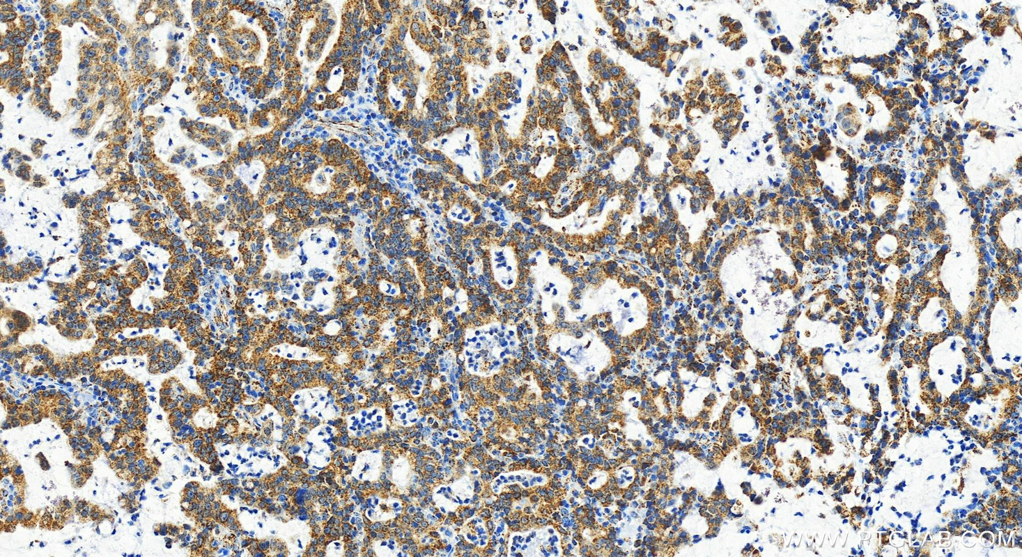 IHC staining of human stomach cancer using 83517-3-RR