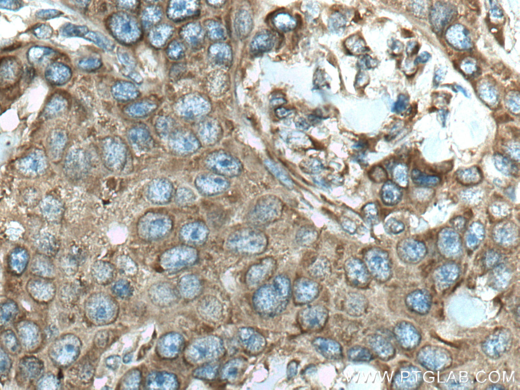 IHC staining of human breast cancer using 67683-1-Ig (same clone as 67683-1-PBS)