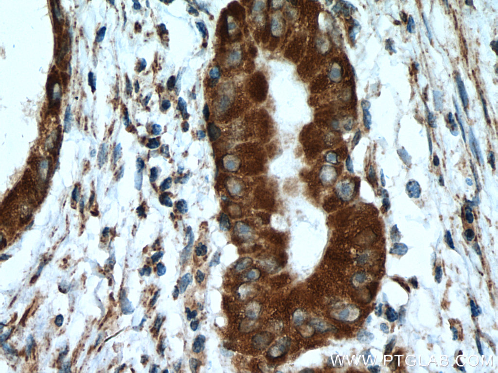 IHC staining of human colon cancer using 16680-1-AP