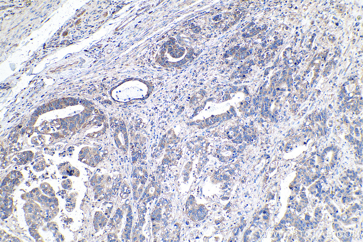 IHC staining of human stomach cancer using 14957-1-AP