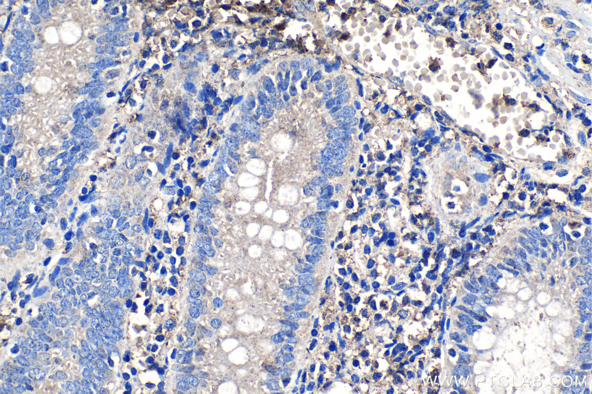 IHC staining of human appendicitis using 17296-1-AP