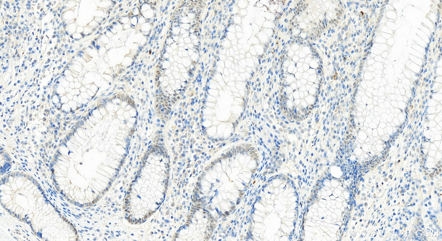 IHC staining of human colon cancer using 25707-1-AP