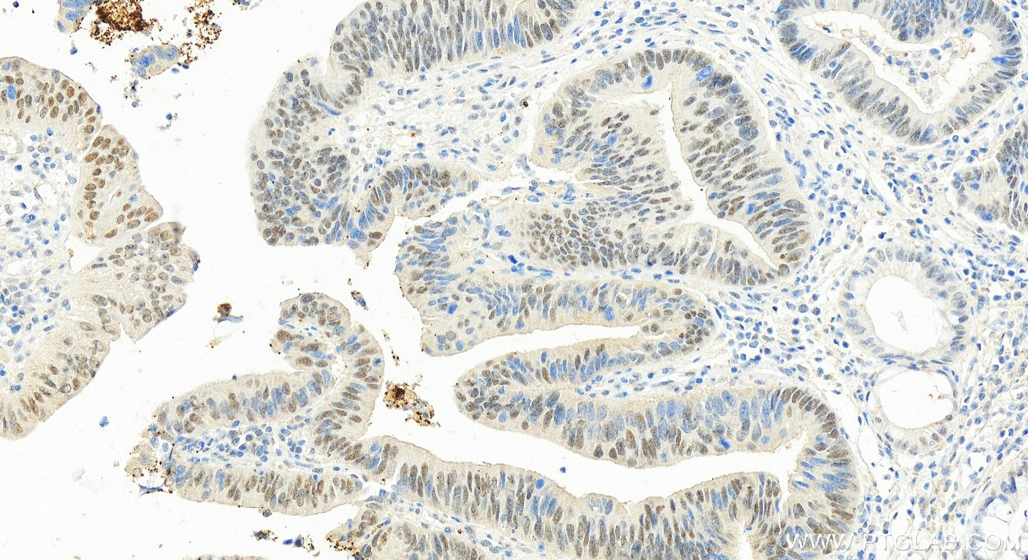 IHC staining of human colon cancer using 25707-1-AP