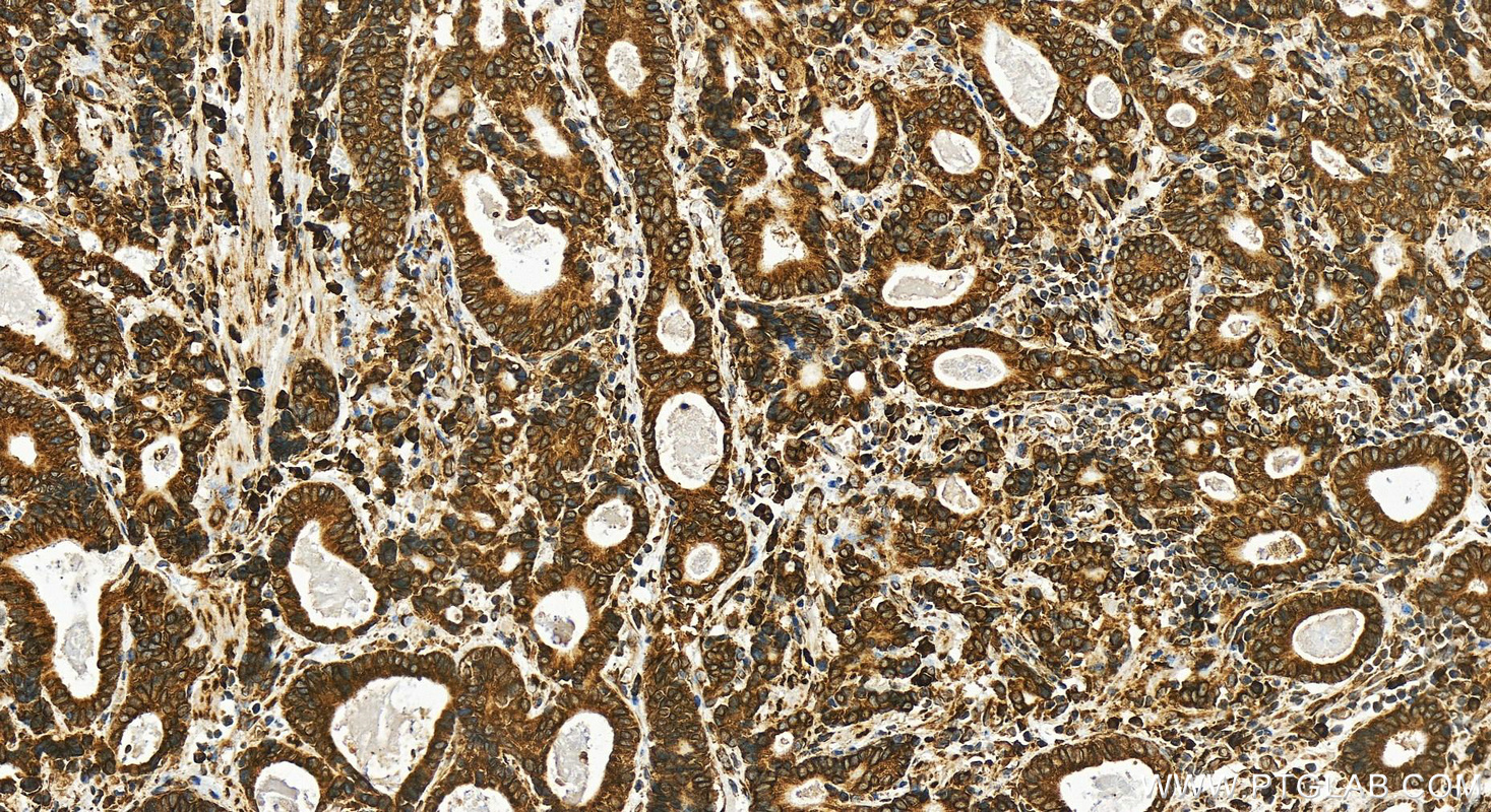 IHC staining of human stomach cancer using 82890-2-RR