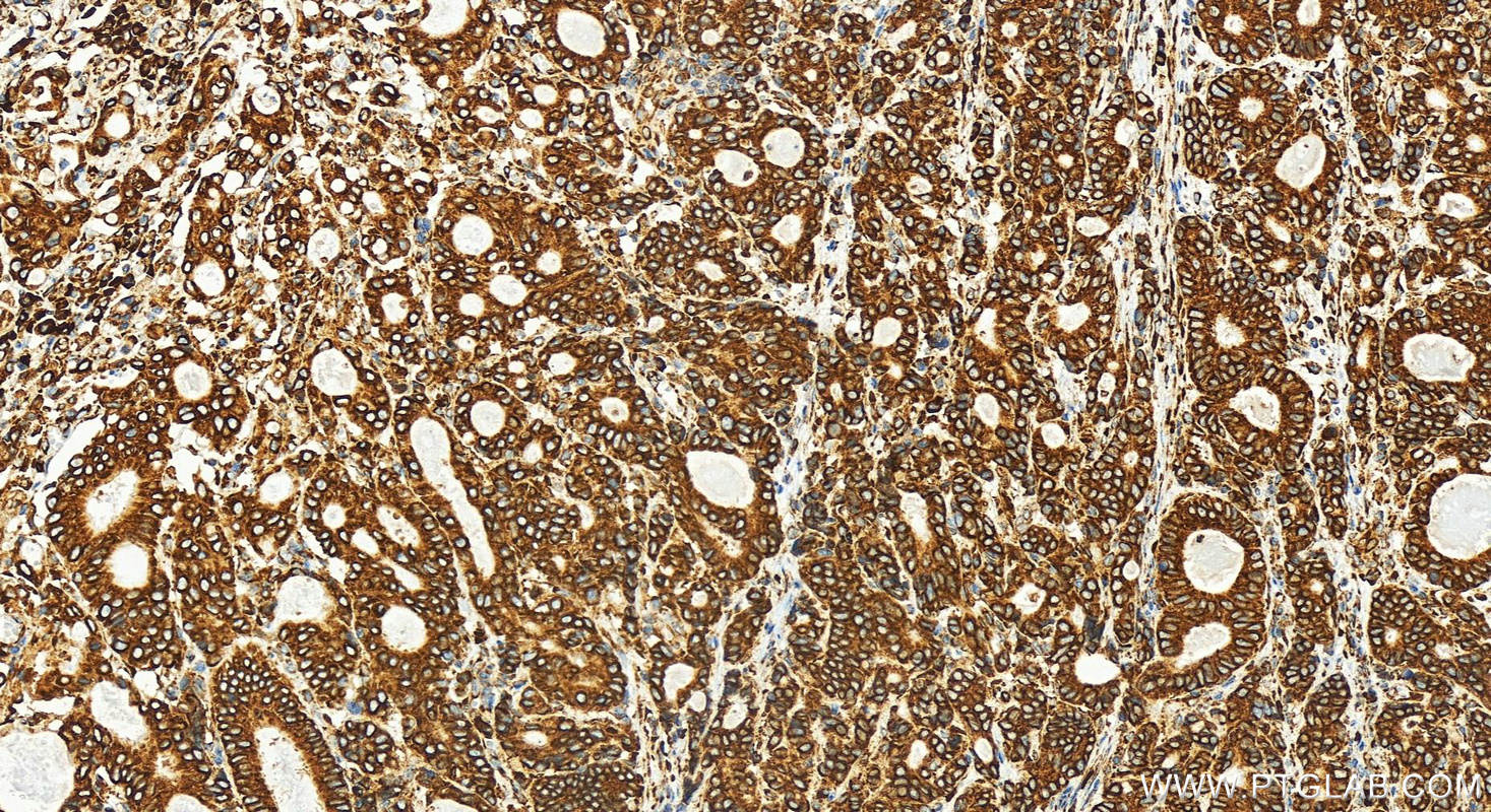 IHC staining of human stomach cancer using 82890-3-RR (same clone as 82890-3-PBS)