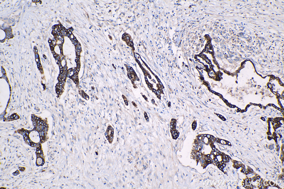 IHC staining of human pancreas cancer using 60073-2-Ig (same clone as 60073-2-PBS)