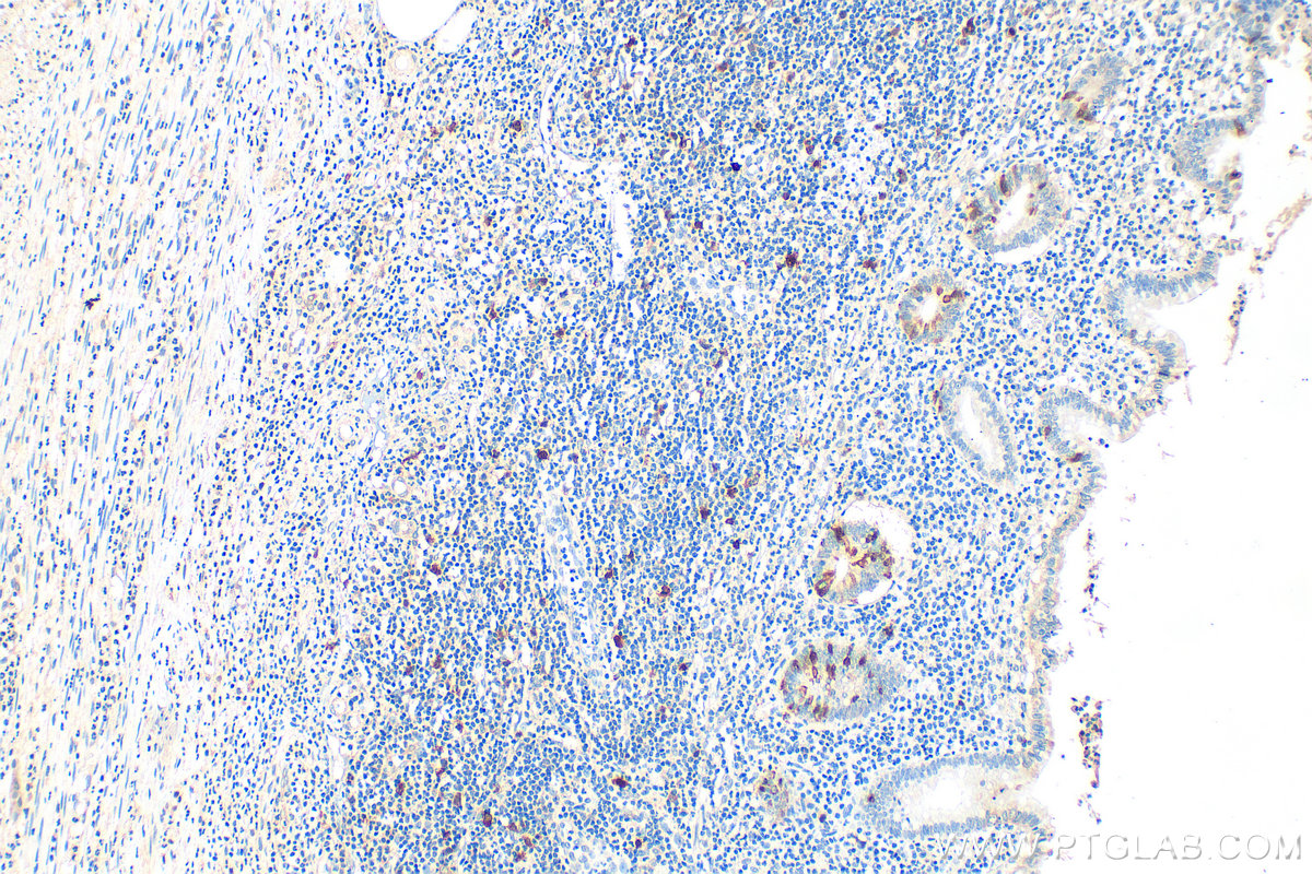 IHC staining of human appendicitis using 11661-1-AP