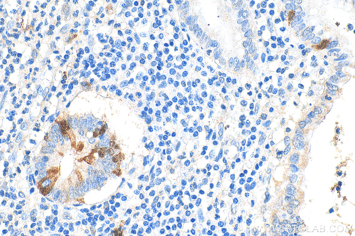 IHC staining of human appendicitis using 11661-1-AP