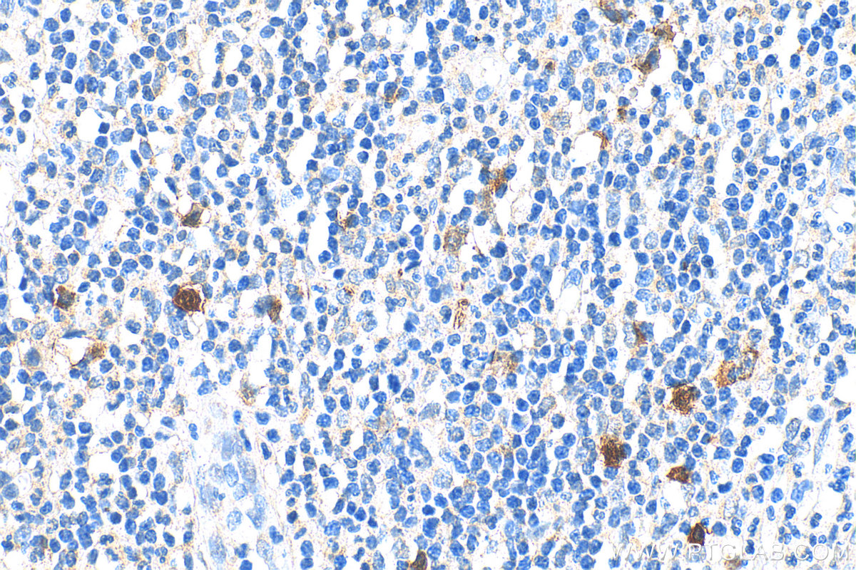 IHC staining of human appendicitis using 11661-1-AP