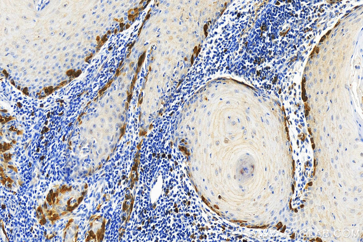 IHC staining of human skin cancer using 67006-1-Ig (same clone as 67006-1-PBS)