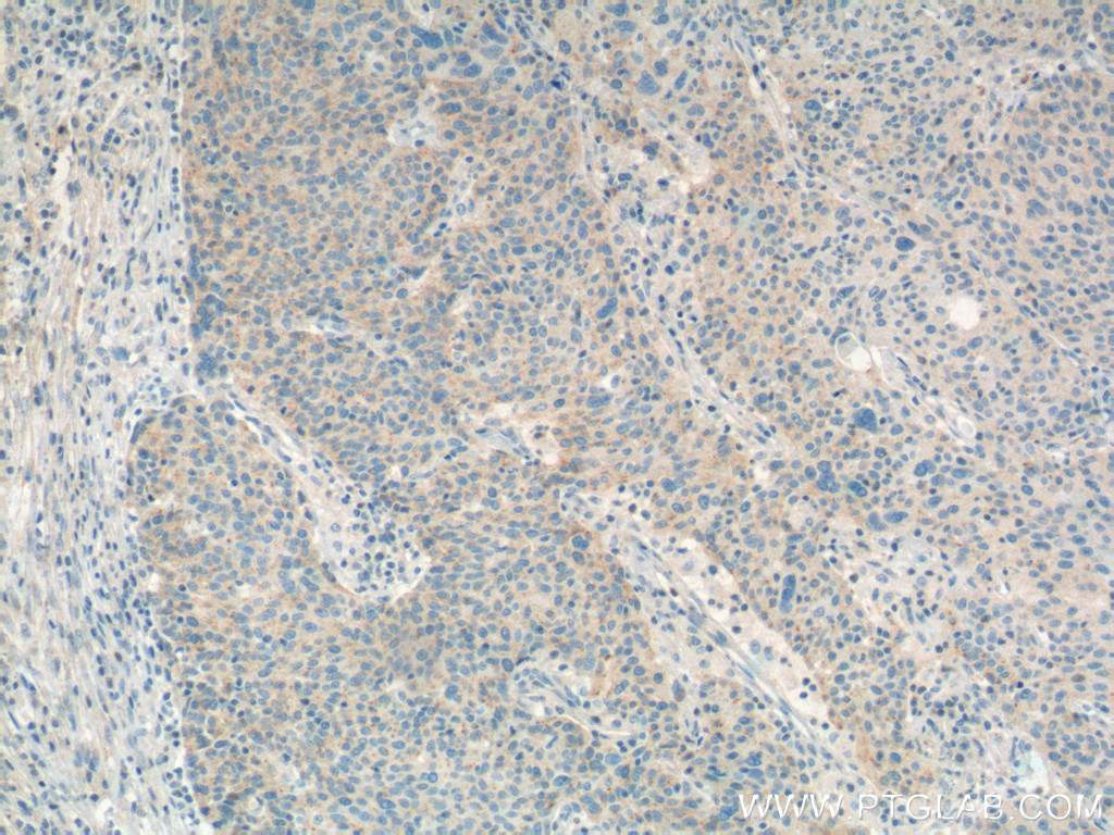 IHC staining of human lung cancer using 66314-1-Ig (same clone as 66314-1-PBS)
