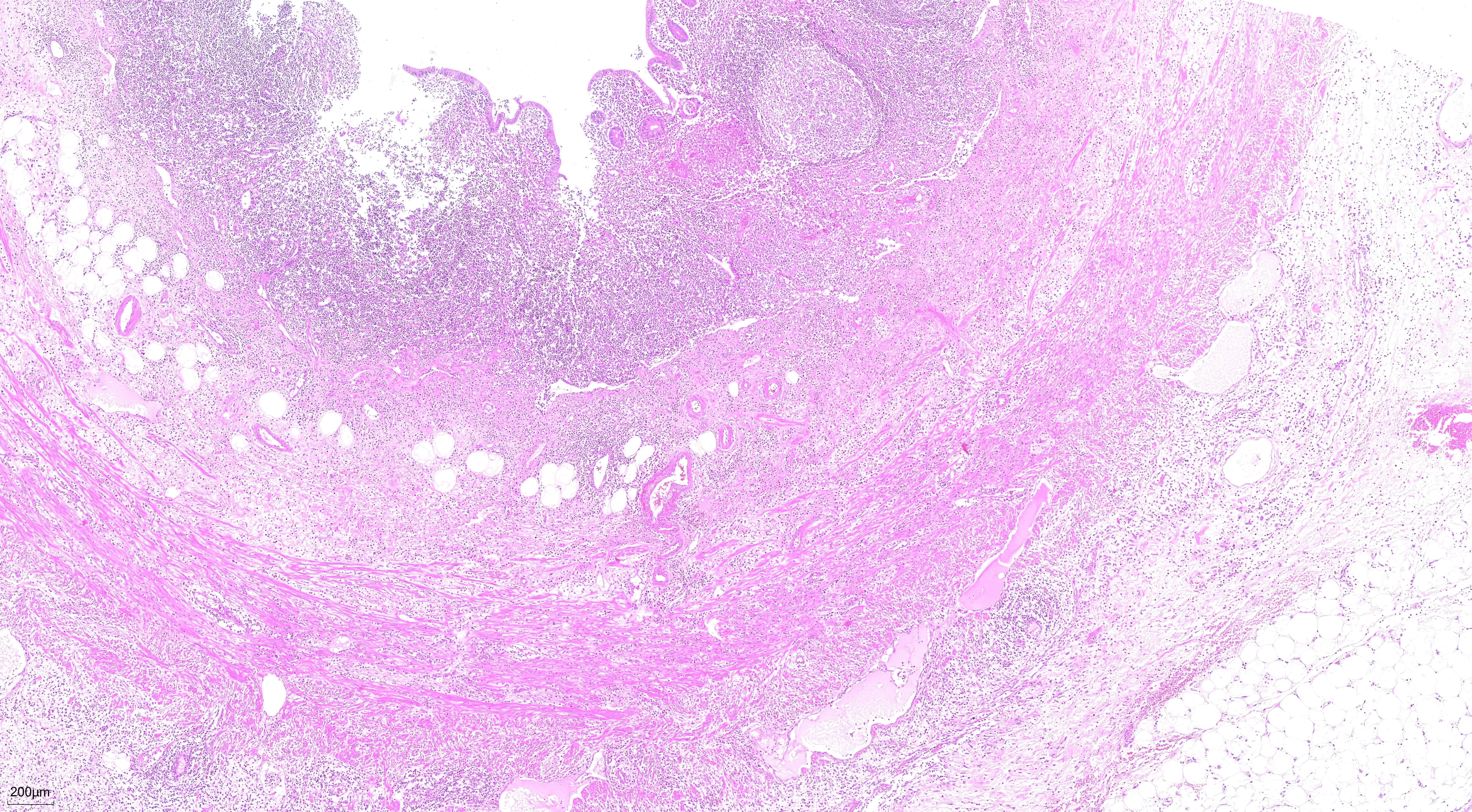 FFPE human appendicitis tissue was stained with PR30004 (Mayer's Hematoxylin Solution) and PR30019 (Eosin Staining Solution).
