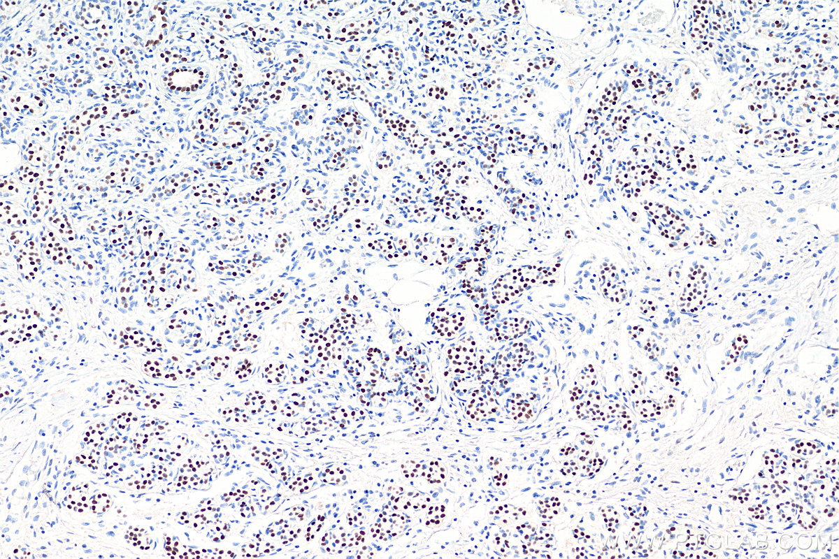 Immunohistochemical analysis of paraffin-embedded human breast cancer tissue slide using 66300-1-Ig (PR antibody) . PR30004 (Mayer's Hematoxylin) was used for counter staining.