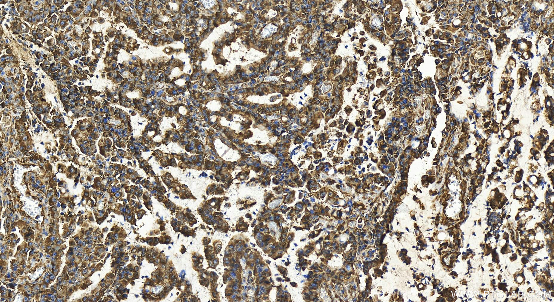 IHC staining of human stomach cancer using 30182-1-AP