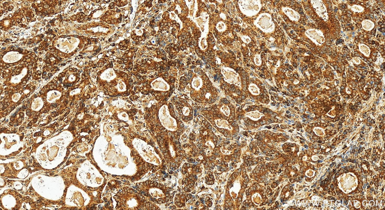 IHC staining of human stomach cancer using 80959-1-RR