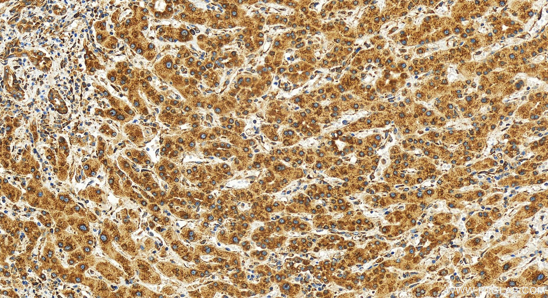 IHC staining of human intrahepatic cholangiocarcinoma using 80959-1-RR