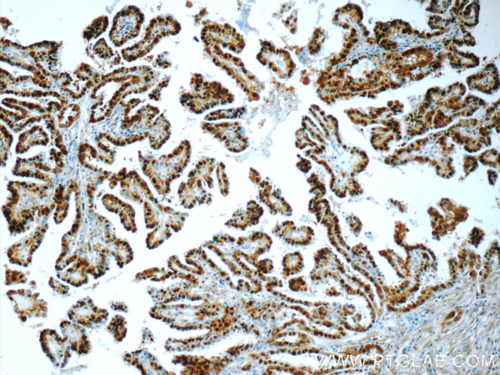 IHC staining of human thyroid cancer using 14987-1-AP